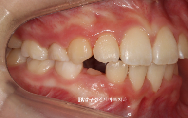 소아 투명교정 인비절라인 퍼스트 후기 기록 관련 이미지 12