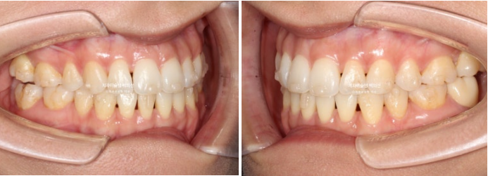 인비절라인 익스프레스 재교정 블랙트라이앵글 치간 삭제 치료기간 6개월 재제작 1회 관련 이미지 9