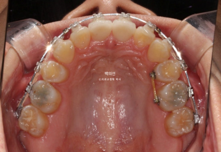 클리피씨 교정에서 인비절라인 변경 마무리 인비절라인 라이트 치료기간 4개월 관련 이미지 2
