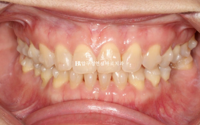 벌어진 치아 교정 인비절라인 라이트 무삭제 라미네이트 치료 관련 이미지 11