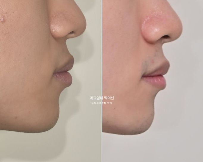 인비절라인 비발치 앞니 돌출 덧니 교정 ? 관련 이미지 19