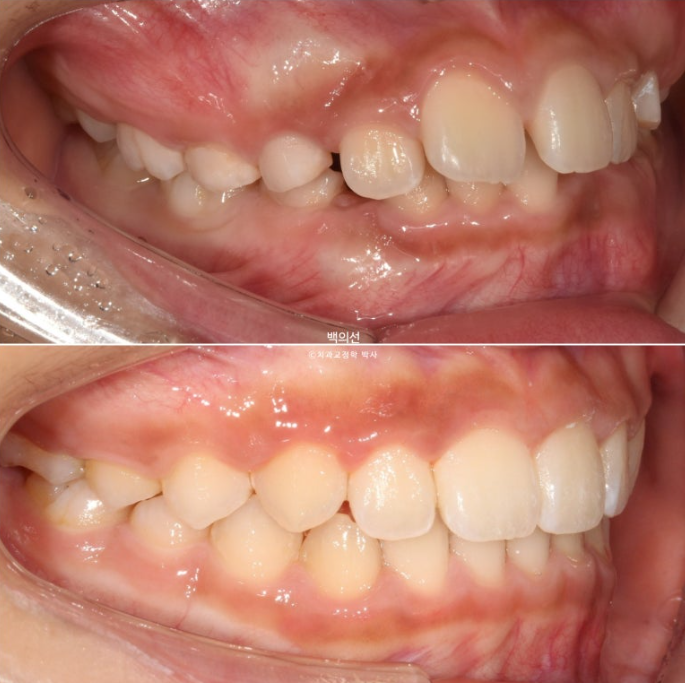 인비절라인퍼스트 어린이 투명교정 과개교합 덧니 악궁확장 돌출 관련 이미지 22