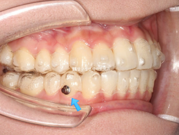 9-Month Invisalign Lite Review|Real Case Improving a Crossbite and Crooked Teeth Together image 5