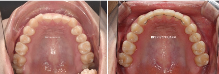 옥니 교정 인비절라인 라이트 옹니 덧니 치료기간 ? 관련 이미지 12