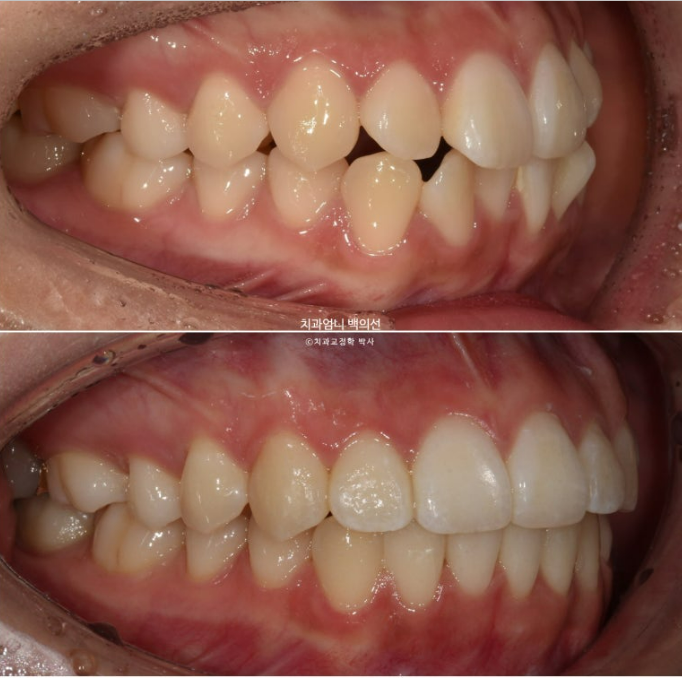 앞니 부분 교정 토끼이빨 덧니교정 ? 관련 이미지 14