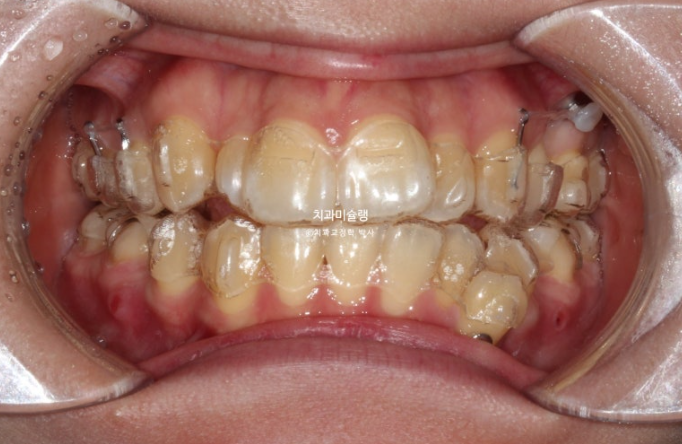 30대 인비절라인 덧니 발치교정 개방교합 치료 관련 이미지 8