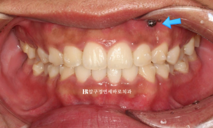 Can Invisalign Lite Correct Deep Bite and the Occlusal Plane? | A Real Case With 14 Aligners Over 4 Months image 5