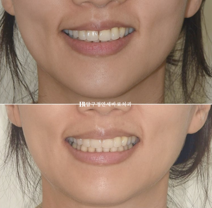 재교정 고민 중이라면 꼭 보세요! 4개월 만에 달라진 앞니 관련 이미지 10