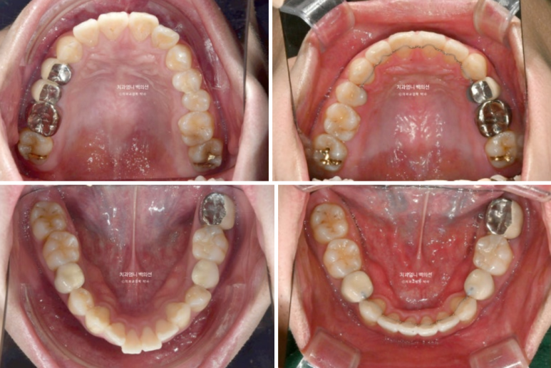 돌출입 발치 교정 인비절라인 후기 미니스크류 관련 이미지 17