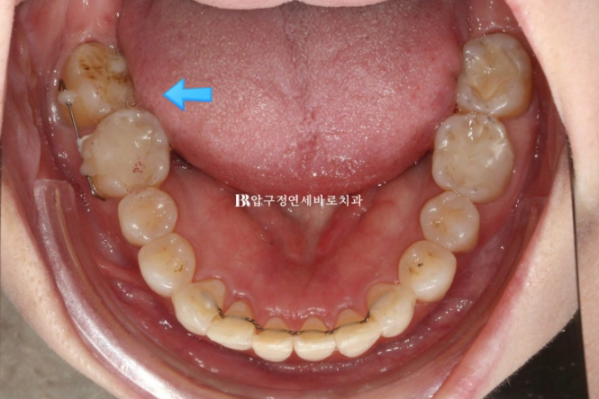40대 발치교정 대신 인비절라인 라이트? 10개월 치료로 어디까지 가능할까요? 관련 이미지 12