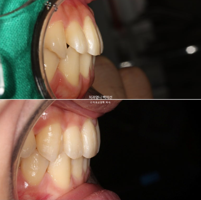 인비절라인 비발치 앞니 돌출 교정 치료기간 2년 5개월 관련 이미지 18