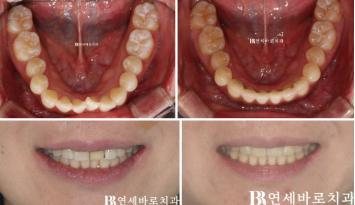 앞니가 부러져 임플란트 해야 한다고 들었는데, 교정으로 살릴 수 있을까요?|보철교정 실제 사례 관련 이미지 7