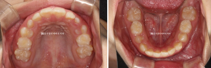 A Child’s Protruding Teeth Correction Review: Difficulty Closing the Lips image 8
