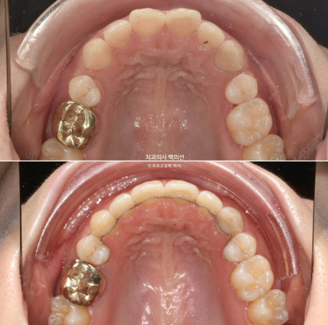 인비절라인 라이트 재교정 발치공간 벌어짐 ? 관련 이미지 10