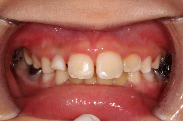 치아 흰색 얼룩 ? 갈아내지 않고 치료하는 법 관련 이미지 5