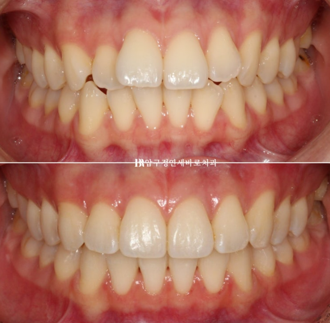Orthodontic Treatment for International Students: Is Short-Term Treatment Possible in Korea? | A Real 5-Month Front Teeth Partial Orthodontic Case image 1