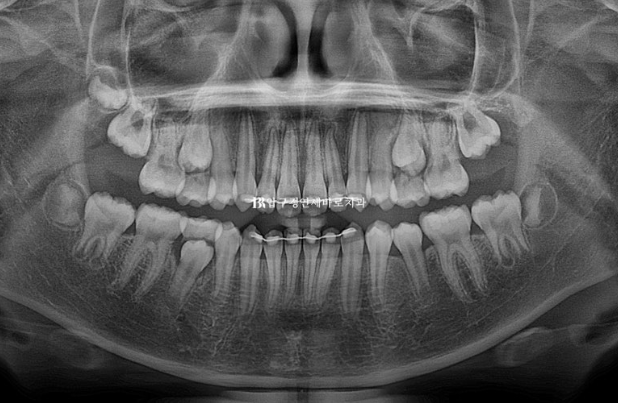 A Child’s Protruding Teeth Correction Review: Difficulty Closing the Lips image 17
