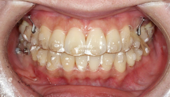 비발치 돌출입 인비절라인 교정 가위교합 중심선 맞추기 관련 이미지 12