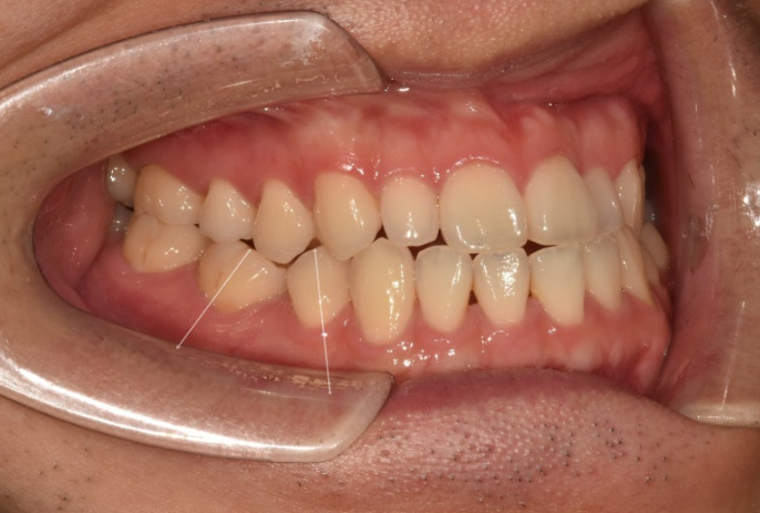 주걱턱 교정 반대교합 소구치 선천적 결손 부정교합 비발치 교정 후기 관련 이미지 4