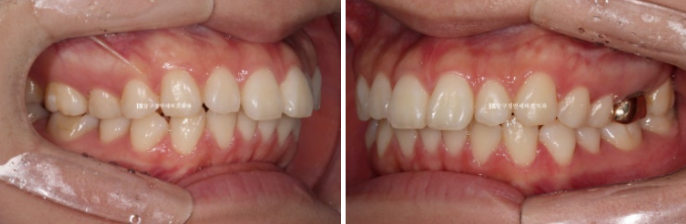Gummy Smile Correction, Gummy Smile Orthodontics, Rabbit Teeth Correction image 4
