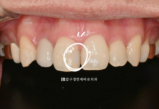 Icon White Spots on Teeth: Resin Treatment for White Spot Lesions image 6