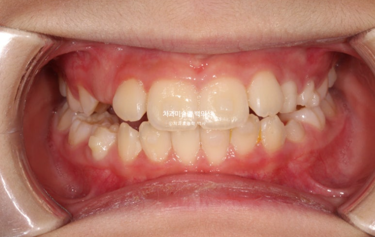 어린이 무턱 성장교정 덧니 인비절라인 퍼스트 악궁확장 치료기간 2년 관련 이미지 18