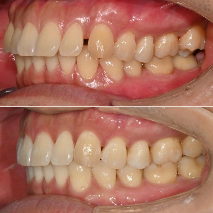 가위교합 벌어짐 중심선 과개교합 인비절라인 라이트 교정 관련 이미지 17
