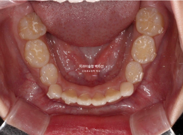어린이 비대칭 반대교합 주걱턱 인비절라인 퍼스트 프리올소 성장 교정 관련 이미지 15