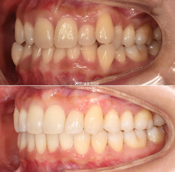 옥니 덧니 과개교합 반대교합 중심선 인비절라인 치료기간 1년 관련 이미지 14