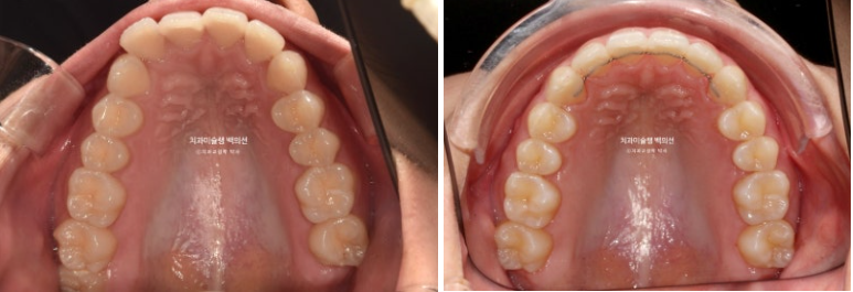 비발치 인비절라인 교정 돌출입 교정 후기 관련 이미지 16