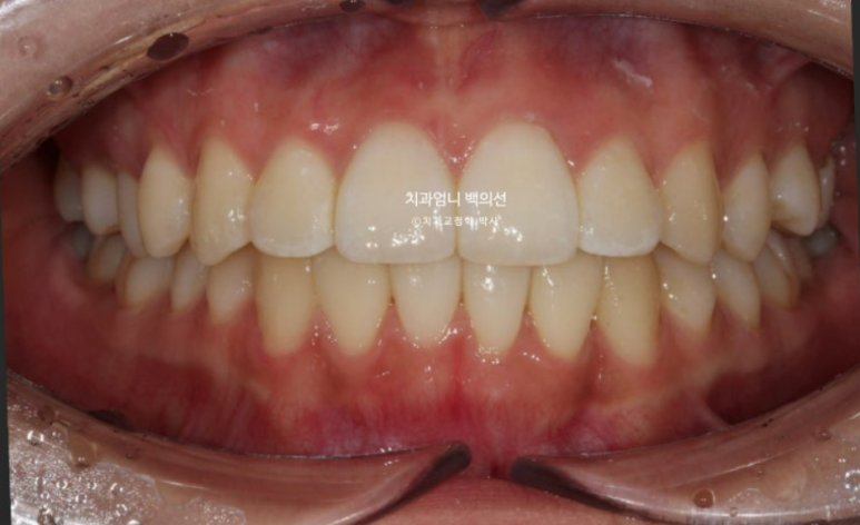 앞니 부분 교정 급속 교정 토끼이빨 MTA 미니튜브 치간삭제 치료기간 9개월 관련 이미지 10