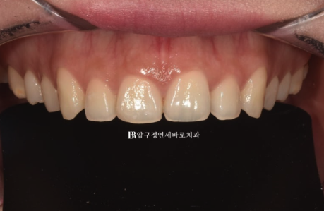 강남 무삭제 라미네이트, 치아 삭제 없이 스마일라인까지 바꿀 수 있을까? 관련 이미지 3