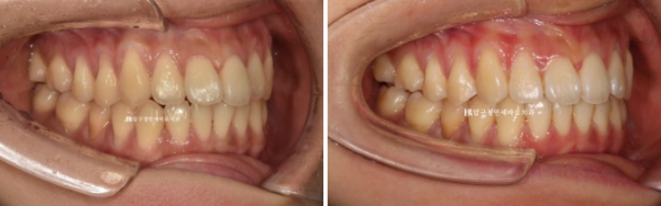 인비절라인 익스프레스 토끼이빨 교정 기간? 인비절라인 종류는? 관련 이미지 11