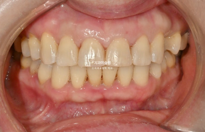 50대 치아교정 돌출 치아벌어짐 중년교정 관련 이미지 12