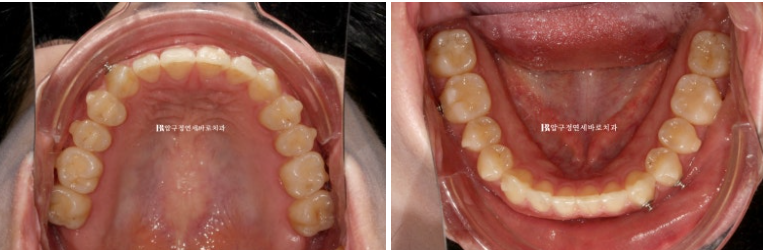옥니 교정 인비절라인 라이트 옹니 덧니 치료기간 ? 관련 이미지 8