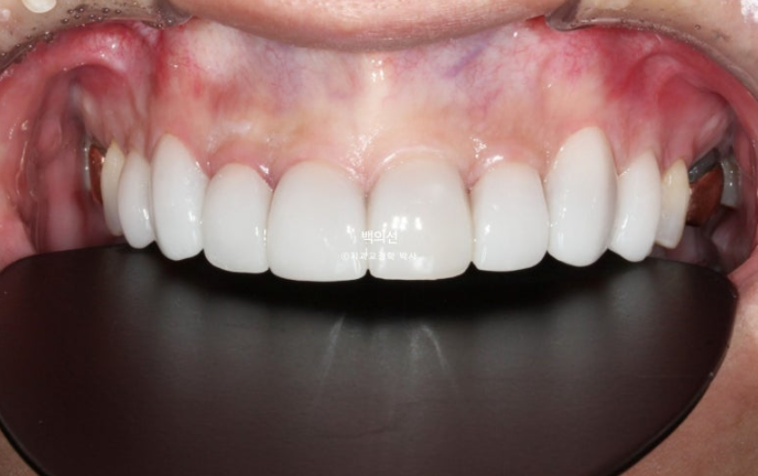 Treatment Review: No-Prep Laminate for Tetracycline-Stained Teeth image 13