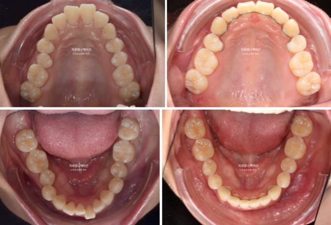 돌출입 교정 인비절라인 발치 교정 후기 관련 이미지 15