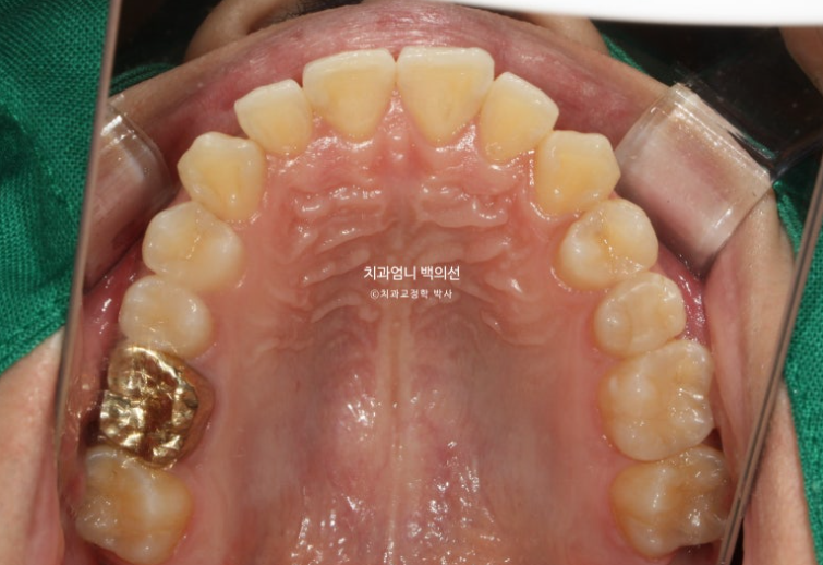 인비절라인 비발치 앞니 돌출 교정 치료기간 2년 5개월 관련 이미지 4