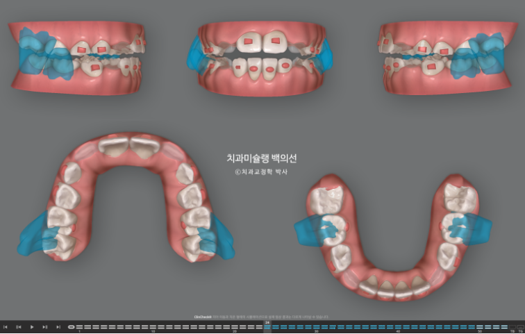 어린이 무턱 성장교정 덧니 인비절라인 퍼스트 악궁확장 치료기간 2년 관련 이미지 8