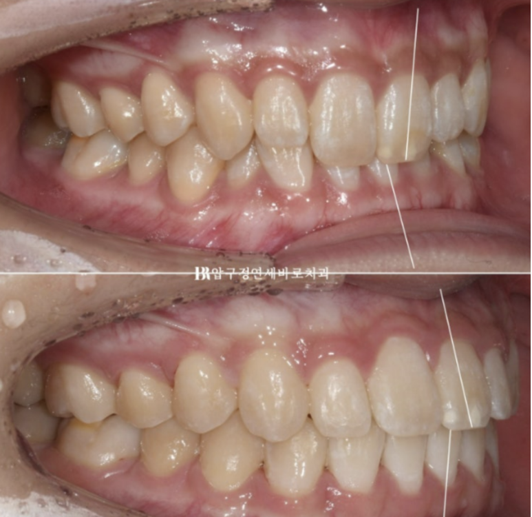 옥니교정 / 웃을때 아랫니만 보여요. 앞니 노출도 교정? 관련 이미지 11