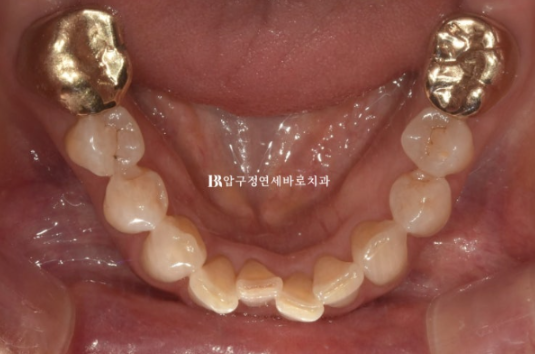 50대 치아교정 후기 | 앞니 부분교정과 무삭제 라미네이트로 자연스러운 안티에이징 관련 이미지 5