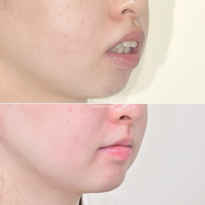 심한 돌출입 입술부전증 호두주름 발치교정 치료 관련 이미지 1