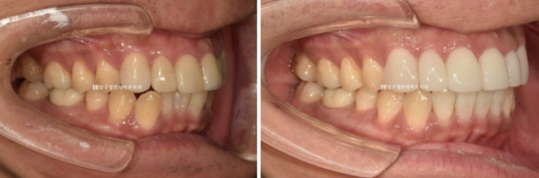 40대 치아교정 인비절라인 라이트 덧니 교정 어금니 교합 부작용 관련 이미지 13