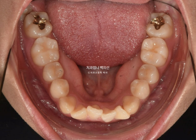 앞니 부분 교정 급속 교정 토끼이빨 MTA 미니튜브 치간삭제 치료기간 9개월 관련 이미지 6