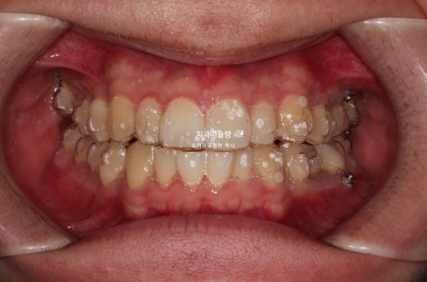 비대칭 비발치 거미스마일 잇몸미소 중심선 가위교합치료 무삭제 라미네이트 관련 이미지 8