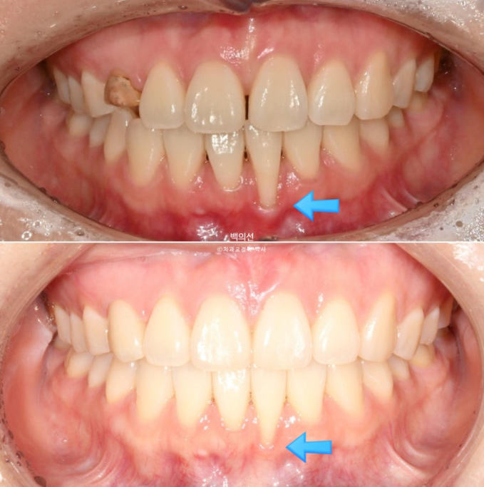 매복 결손 잔존유치 라미네이트 크라운 캔팅 인비절라인 라이트 치료 관련 이미지 19
