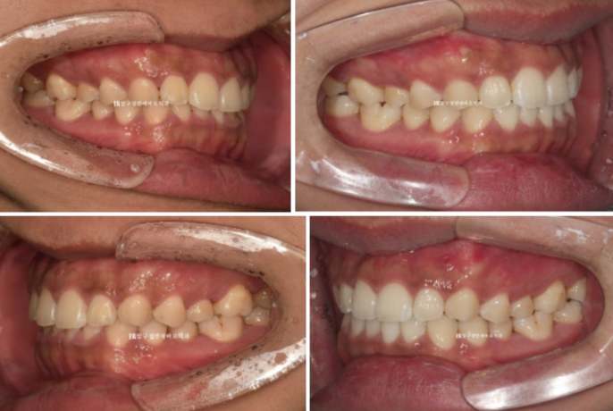 Can Invisalign Lite Correct Deep Bite and the Occlusal Plane? | A Real Case With 14 Aligners Over 4 Months image 7