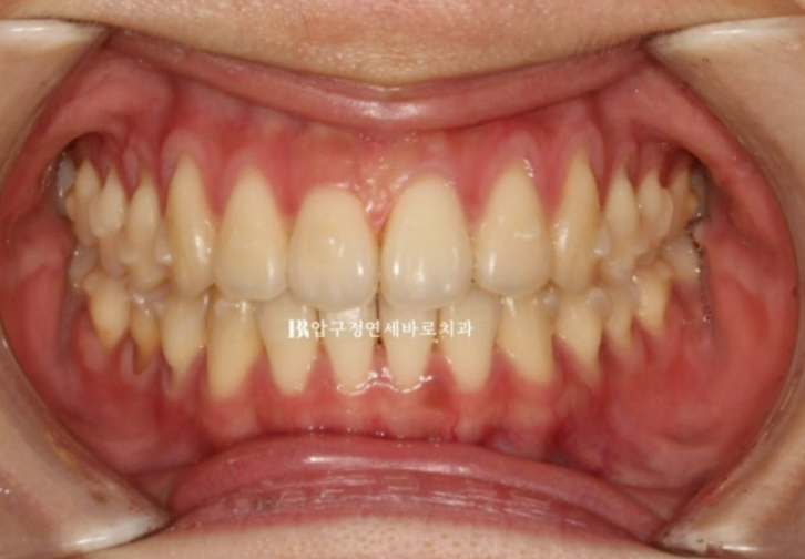 인비절라인 익스프레스 토끼이빨 앞니교정 ? 관련 이미지 6