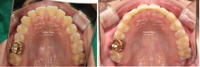 인비절라인 비발치 앞니 돌출 덧니 교정 ? 관련 이미지 15