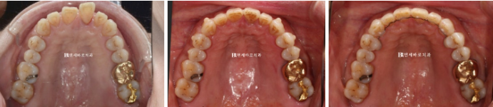 50대 치아벌어짐 단기 교정 가능할까요? 관련 이미지 3